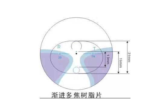美麗島多焦鏡適合的人群，需要注意的事項(xiàng)