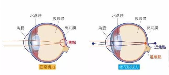 500度近視又老花，戴上美麗島多焦鏡煩惱全解決，46歲的周先生樂壞了